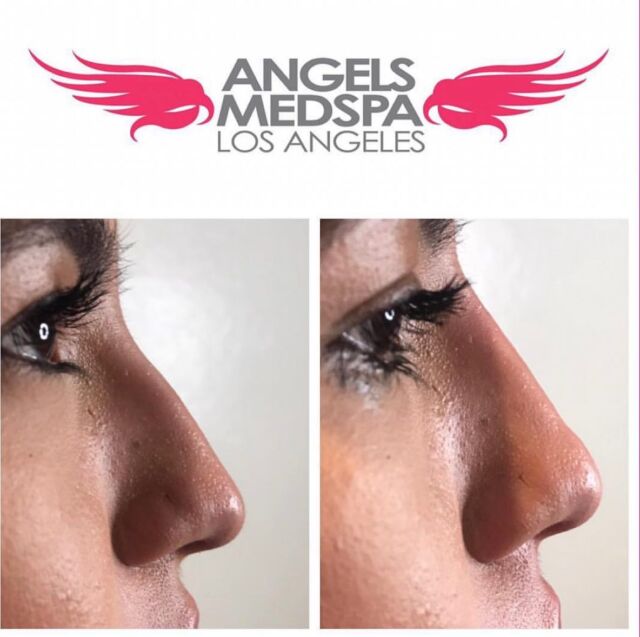 Angels Med Spa skin rejuvenation aesthetic injectables in