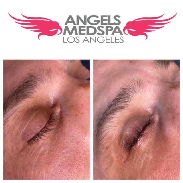 Angels Med Spa skin rejuvenation aesthetic injectables in